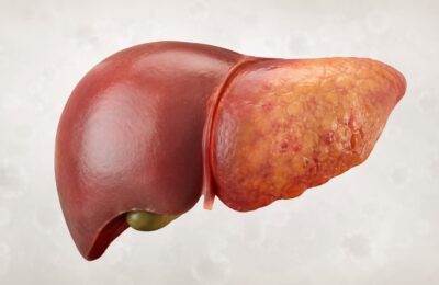 Fígado adoecido avança, muitas vezes, de forma silenciosa.